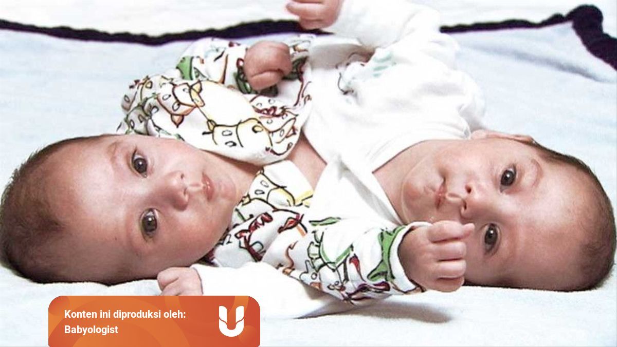 Bayi Kembar Siam Dapat Dicegah Atau Tidak Ya Kumparan 