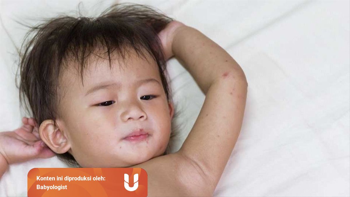 Gejala Dan Alasan Mengapa Hfmd Dapat Mewabah Kumparan Com