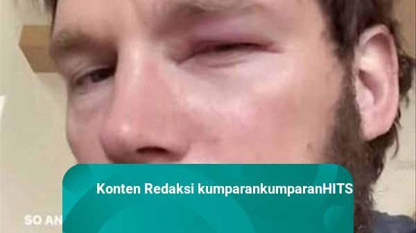 5 Berita Populer: Chris Pratt Disengat Lebah; Black Adam Nggak Masuk DC Universe