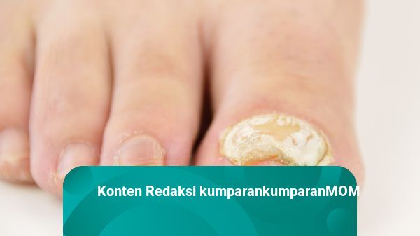 Gejala Infeksi Jamur Kuku Kaki pada Ibu Hamil