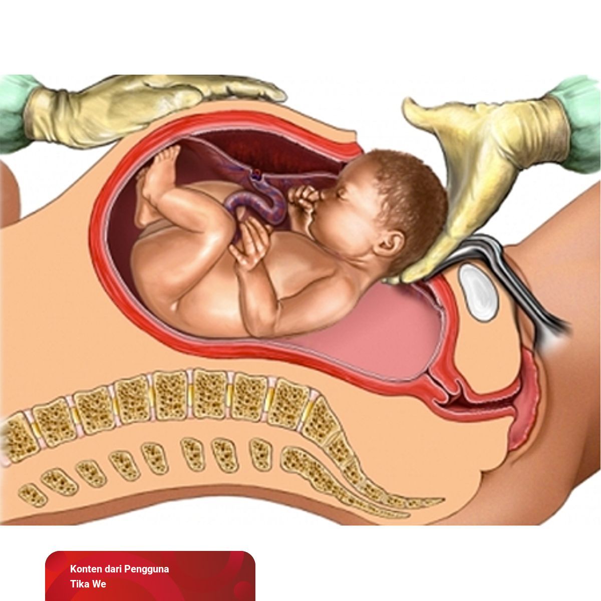 12 Fakta Ini Hanya Dialami Emak-Emak Caesarian | kumparan.com