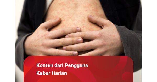 Penyakit Campak Pada Orang Dewasa Gejala Cara Mengobati Dan Mencegahnya Kumparan Com