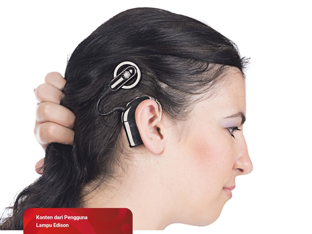 Implan Cochlear, Membantu Yang Tuli Bisa Mendengar | kumparan.com