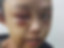 Wajah gadis korban dianiaya tantenya di Kampar. Foto: Dok. Istimewa