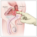 Kanker Prostat