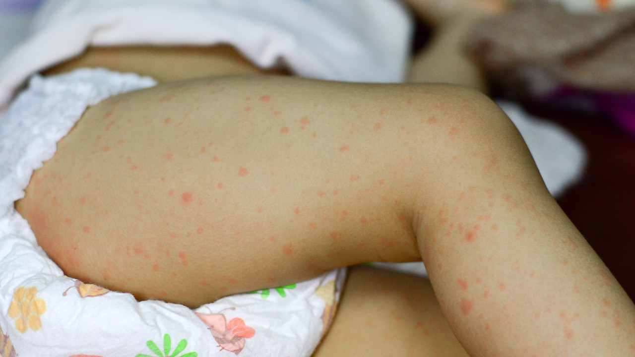 Ilustrasi Anak Campak