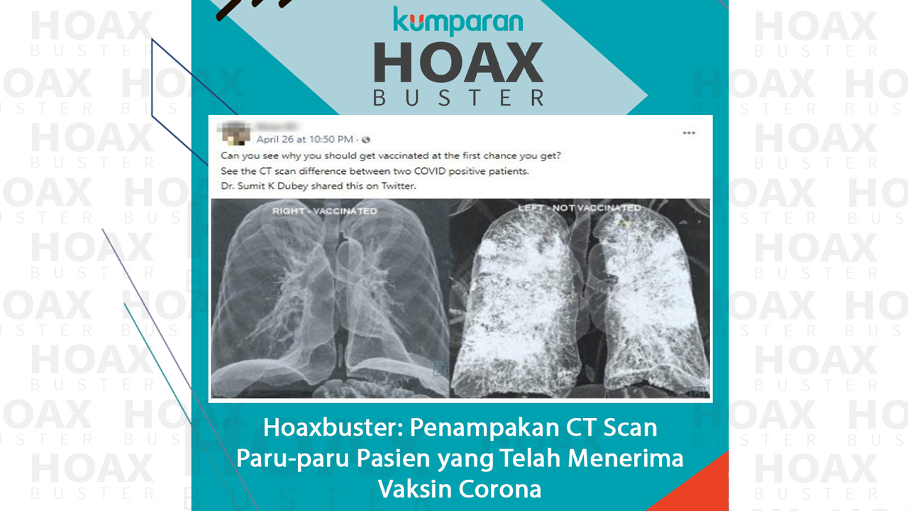 Hoaxbuster Penampakan CT Scan Paru-paru