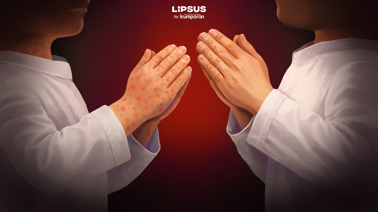 Waspada lonjakan campak saat Lebaran