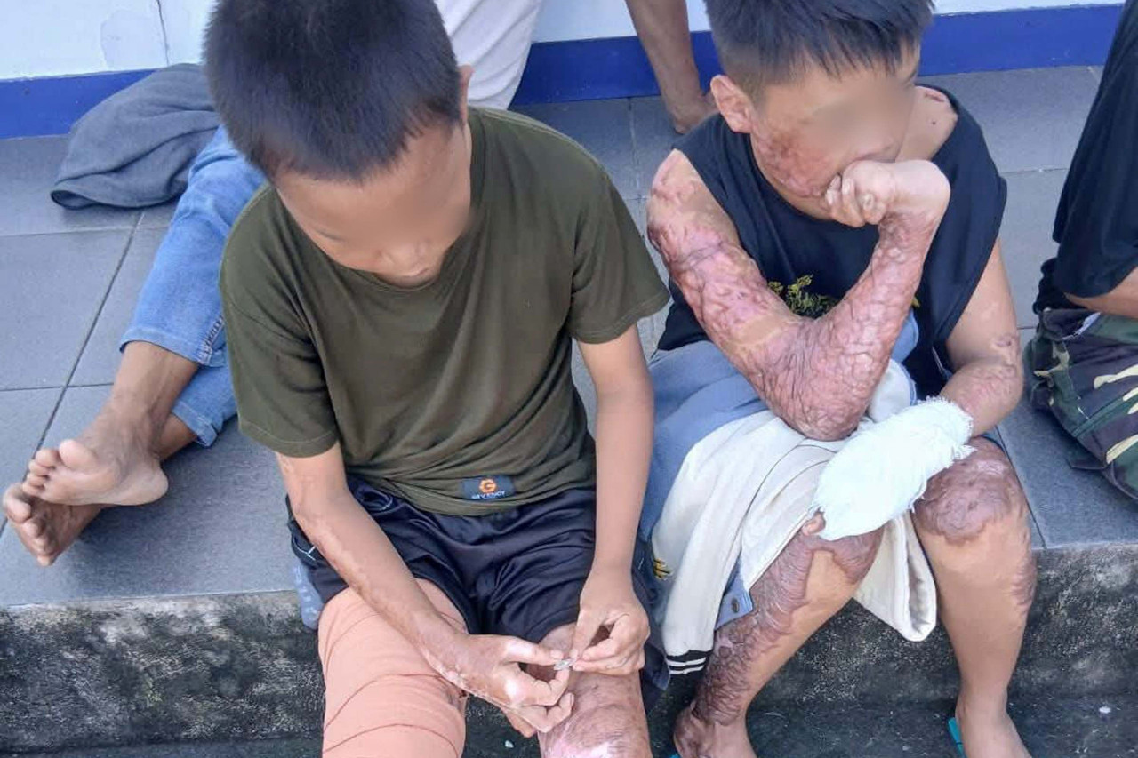 Dua santri di Lombok Tengah yang mengalami luka bakar