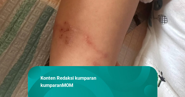 Penyebab Muncul Ruam Berbentuk Cacing di Kaki Anak setelah Main di Rumput
