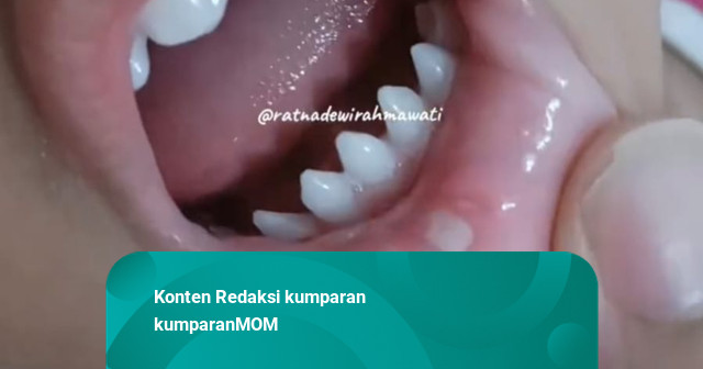 Gigi Anak Bagian Bawah Runcing Semua, Normalkah? Ini Penjelasan Dokter ...