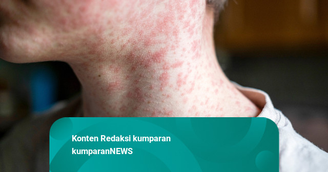 AS Dihantam Wabah Campak, Menkes Disorot Gara-gara Sentimen Antivaksin