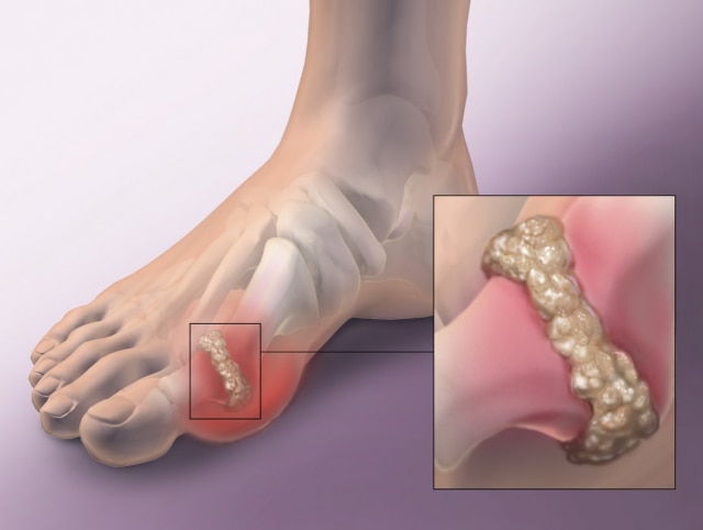 Ilustrasi asam urat (Foto: Pengobatantradisional.biz)