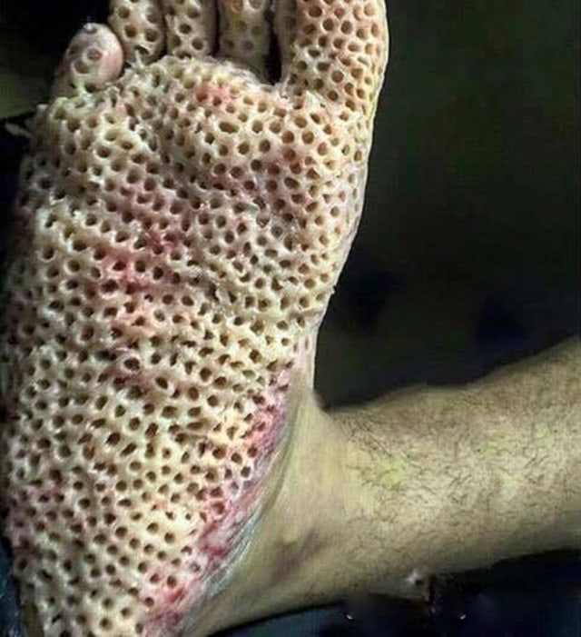 Trypophobia