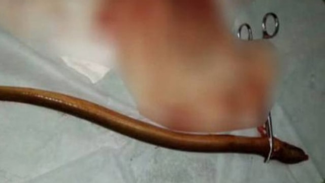 Belut Dikeluarkan dari Perut Manusia (Foto: WeChat)