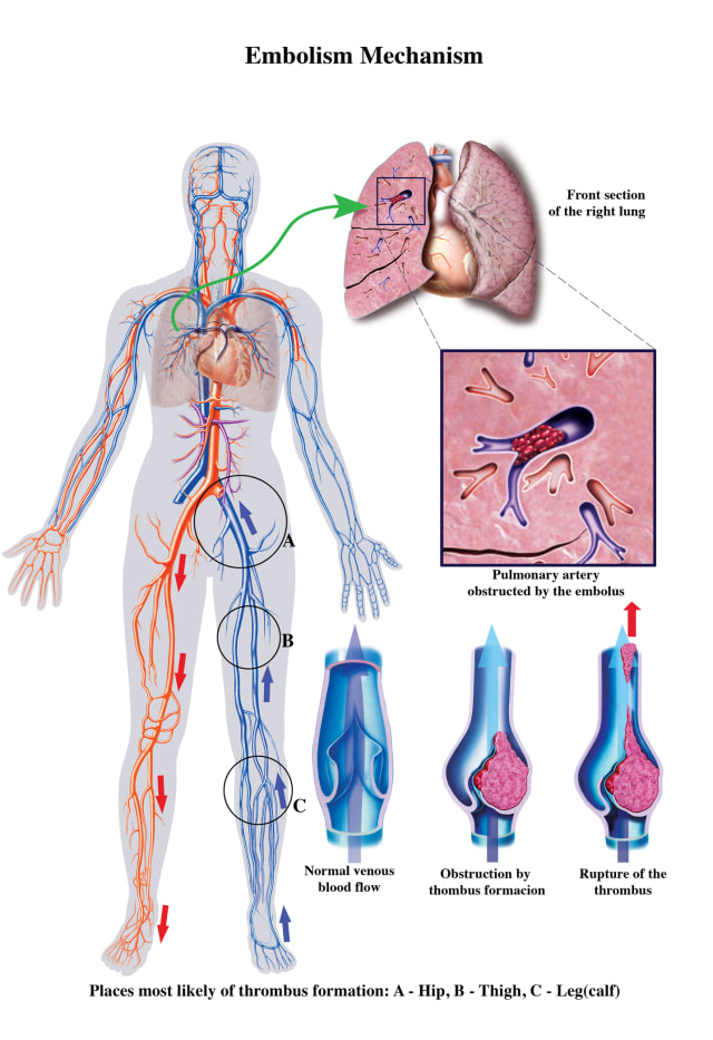 Deep Vein Thrombosis dan pulmonary embolism (Foto: Thinkstock)