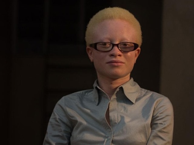 Perpetua Sinkoro, penyintas albinisme Tanzania (Foto: Dok. OCHCR)