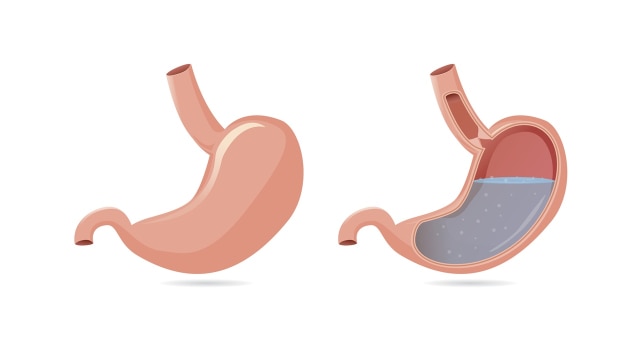 Refluks Asam lambung  (Foto: Thinkstock)