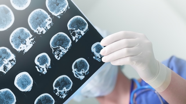 Stroke Foto: Thinkstock