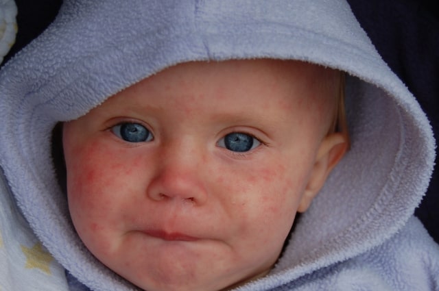 Ilustrasi anak kena campak. Foto: Flickr
