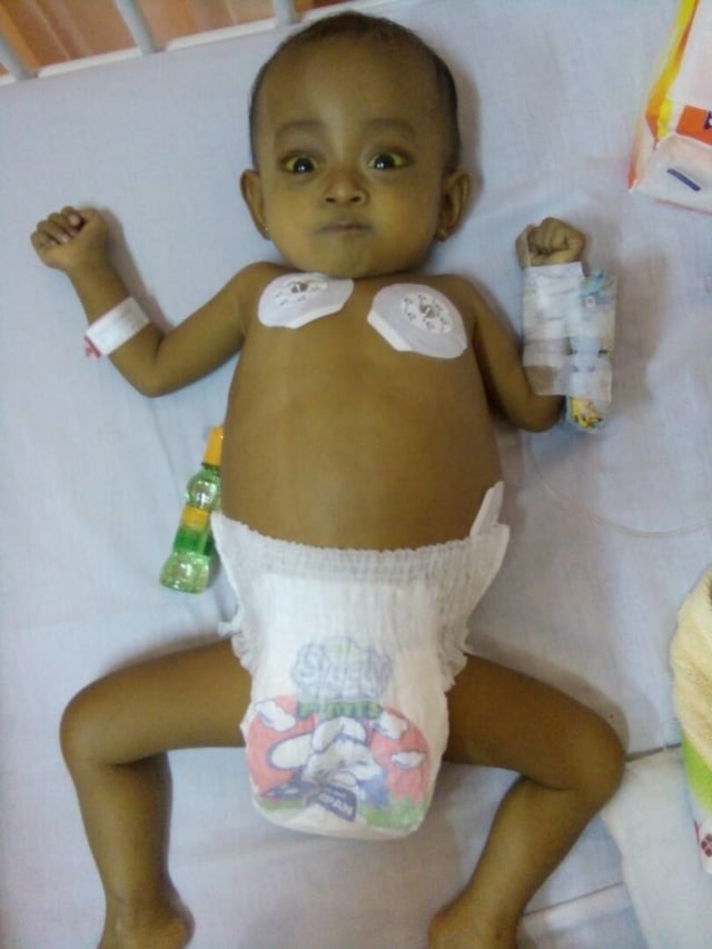 Mishalova, Bayi Penderita Atresia Biller (Foto: Dok. Hanindya)