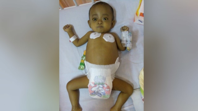 Mishalova, Bayi Penderita Atresia Biller (Foto: Dok. Hanindya)