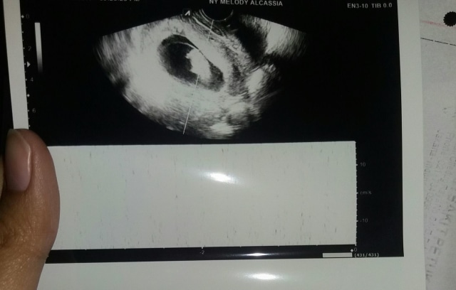 Foto kehamilan Melody. (Foto: Facebook/Melody Alcassia)