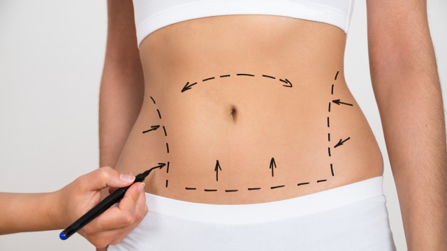 Ilustrasi tindakan operasi plastik (Foto: Thinkstock)