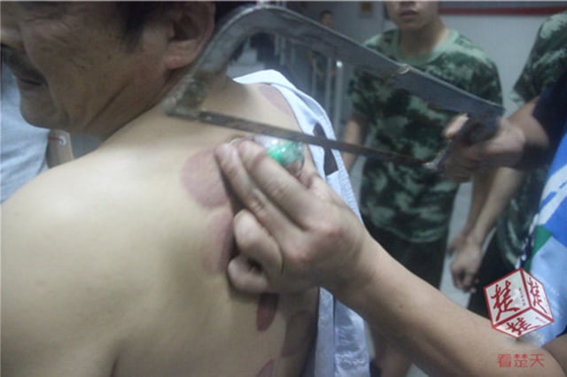 Hu tidak bisa melepaskan alat bekamnya. (Foto: Dok. iFeng)