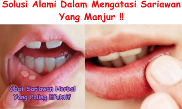 Obat Sariawan Herbal Yang Paling Efektif