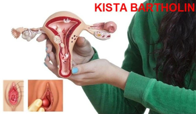 Cara Ampuh Menyembuhkan Kista Bartholin Tanpa Operasi