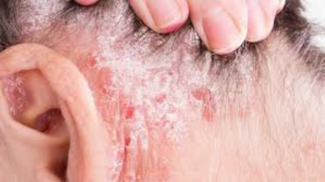 5 Obat Psoriasis Terbaru di Apotik Paling Ampuh Resep Dokter yg Tradisional Kulit Kepala