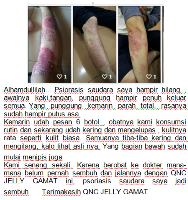 5 Obat Psoriasis Terbaru di Apotik Paling Ampuh Resep Dokter yg Tradisional Kulit Kepala (2)