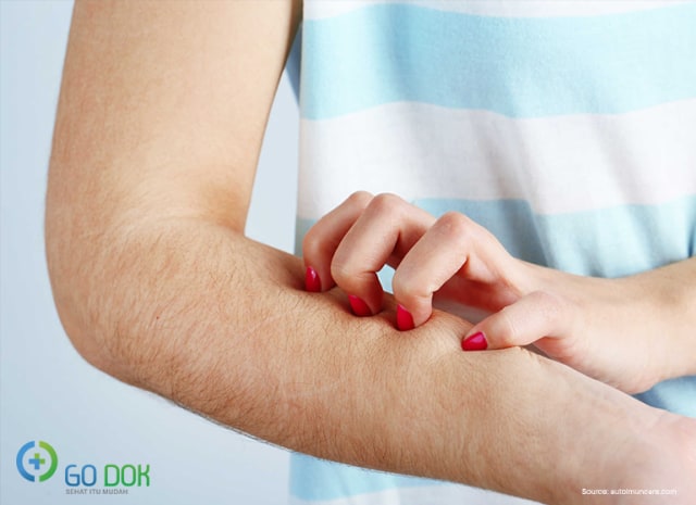 Obat Alami Kurap, Apa Saja? Ini Dia Daftarnya!