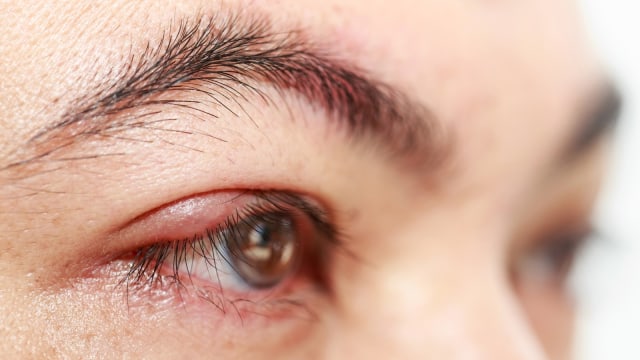 Mata bintitan (Foto: Thinkstock)