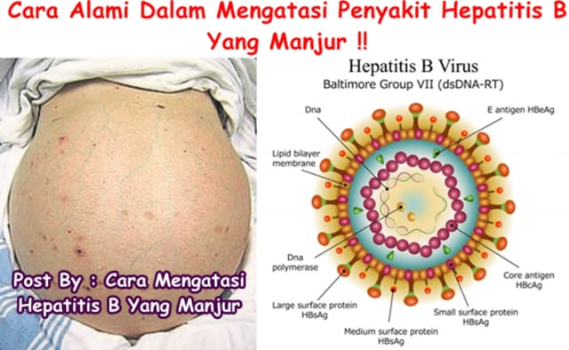 Cara Mengatasi Hepatitis B Yang Manjur