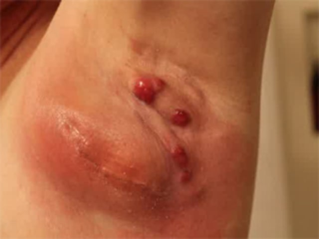 Cara Mengobati Benjolan Di Ketiak Secara Alami