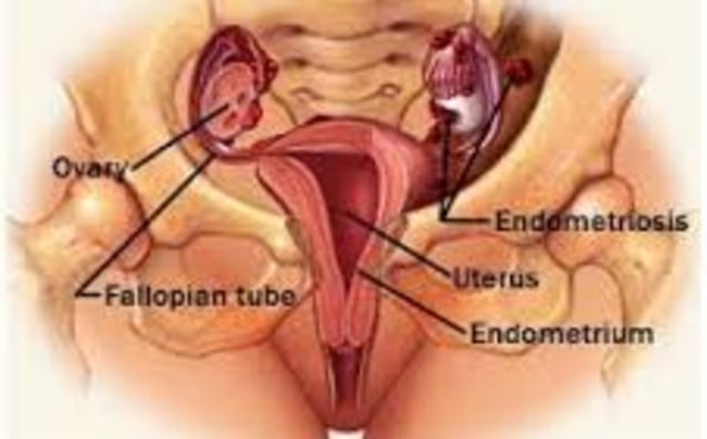Cara Mengobati Kista Endometriosis Secara Alami