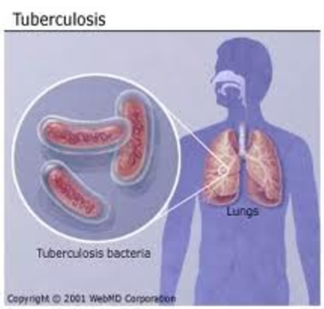 Cara Mengobati Tuberkulosis Secara Alami