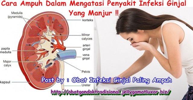 Obat Infeksi Ginjal Paling Ampuh