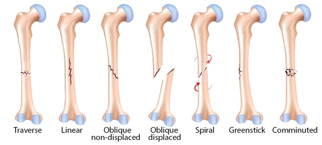 9 Cara Mengobati Patah Tulang Kaki, Tangan, Betis, Bahu Secara Alami Tanpa Operasi yg Lama
