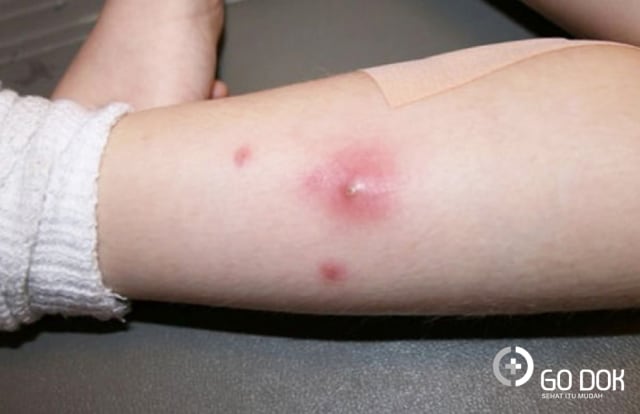 Cara Efektif Atasi Bisul Sebelum Menyebar dan Bertambah Besar