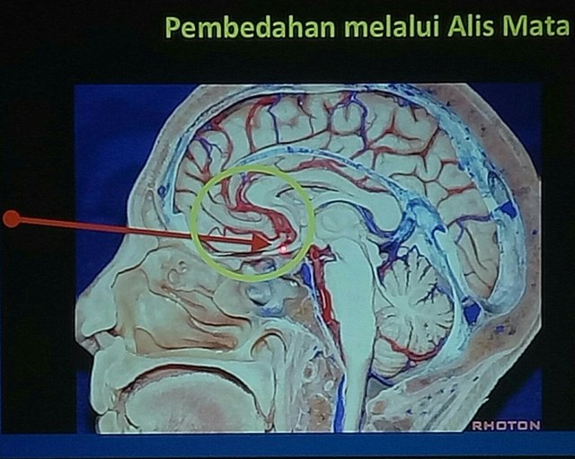 Teknik Keyhole, bedah tumor melalui alis mata. (Foto: Luthfa Nurridha/kumparan)
