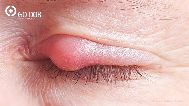 Cara Efektif Obati Bintitan Dijamin Mudah