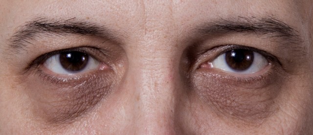 Ilustrasi kantung mata.  (Foto: Thinkstock)