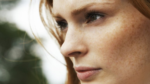 Melasma pada kulit (Foto: Thinkstock)
