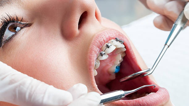 Cara Merawat Gigi Anak yang Menggunakan Kawat (Foto: Dok. istock)