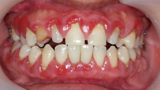 Radang gusi (Foto: Thinkstock)