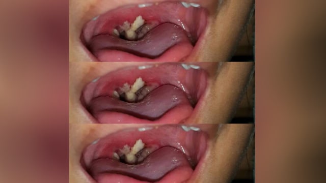 Difteri pada Anak (Foto: Instagram/ @klinikpatrialestari)