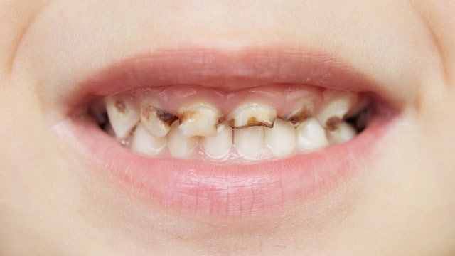 Ilustrasi kerusakan gigi (Foto: Thinkstock)